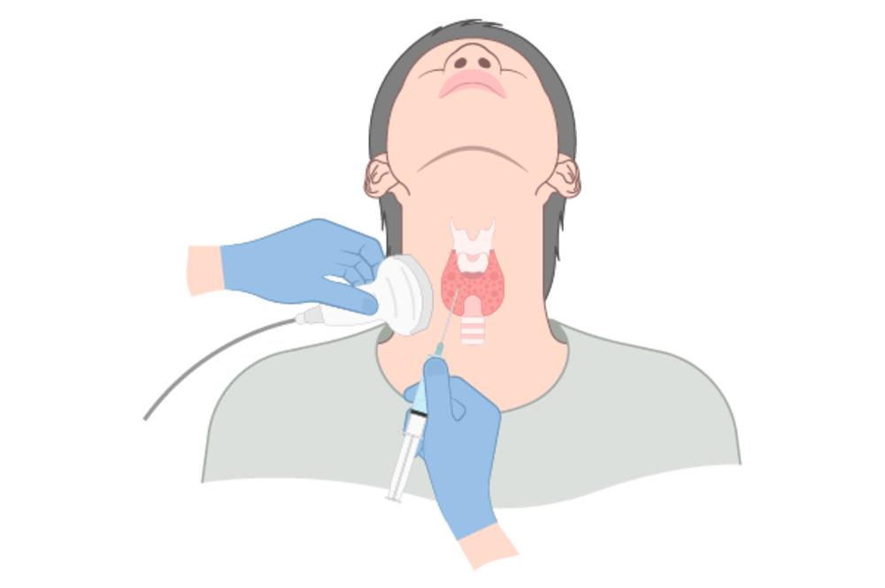 Types of Biopsy & image-guided approach